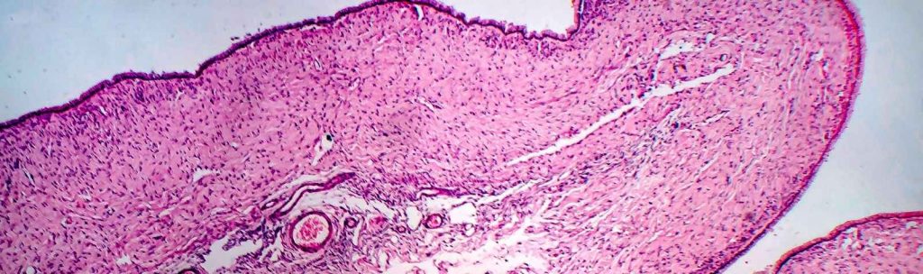shrink ovarian cysts naturally