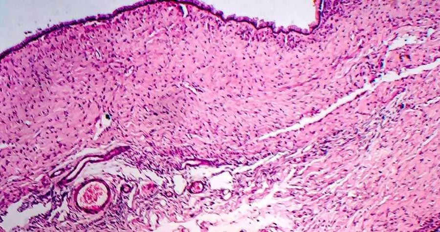 shrink ovarian cysts naturally