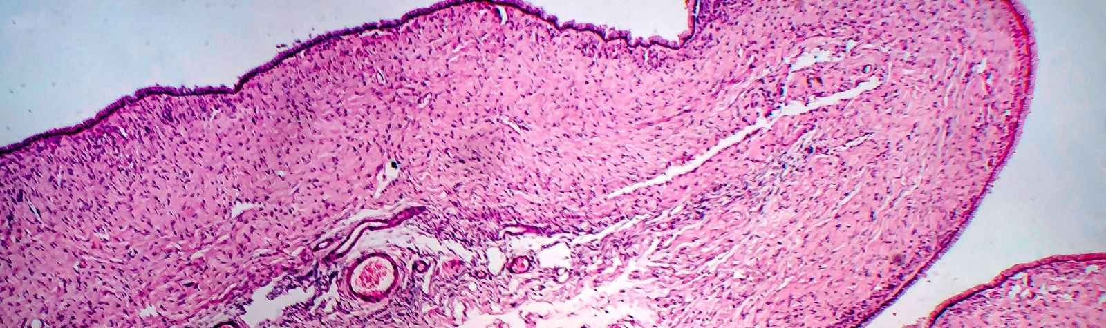 shrink ovarian cysts naturally