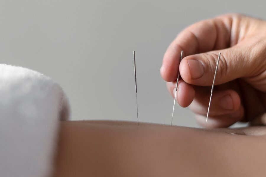 acupuncture for iui